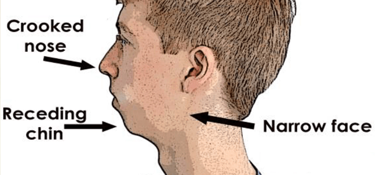 Excess Growth of upper jaw