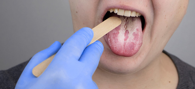 Tongue ulcer