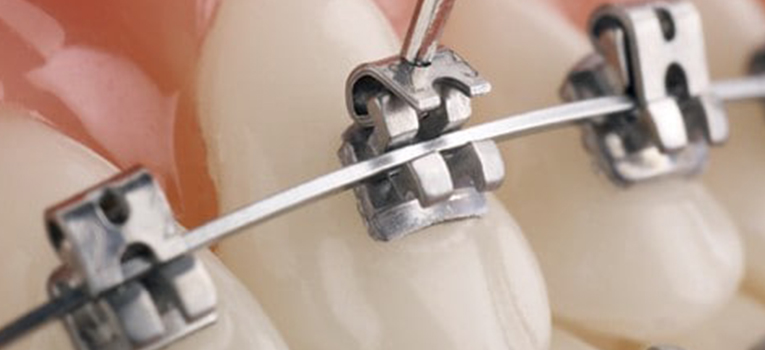 Self-Ligating Braces