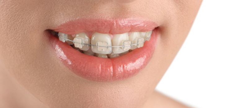 Ceramic Braces