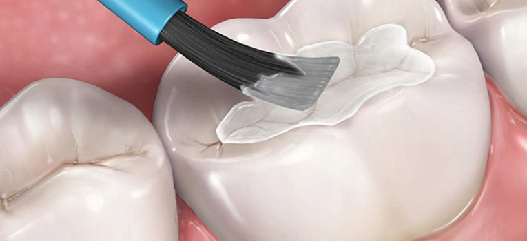 Dental Sealants