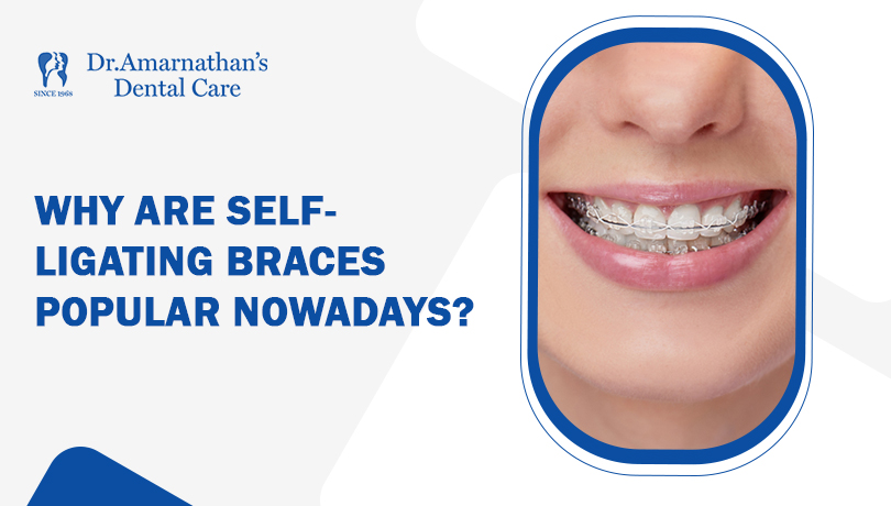 Why are self-ligating braces popular nowadays ?