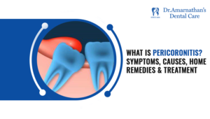 What is Pericoronitis - Dentist in Tambaram | Dental Clinic in Tambaram ...