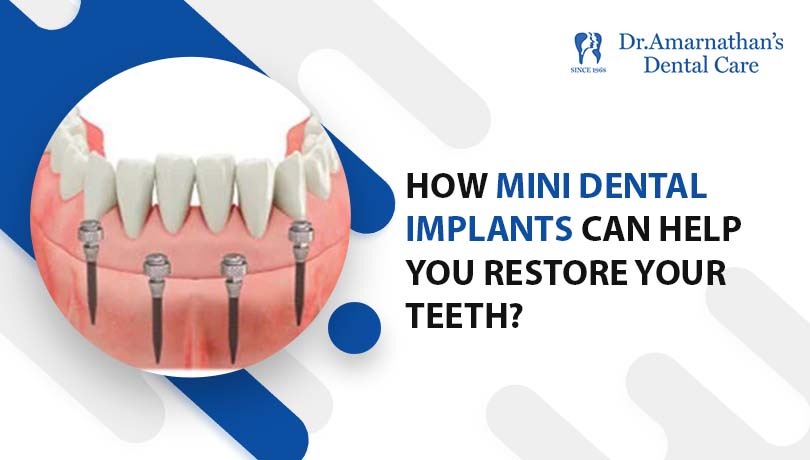 How mini dental implants can help you restore your teeth?