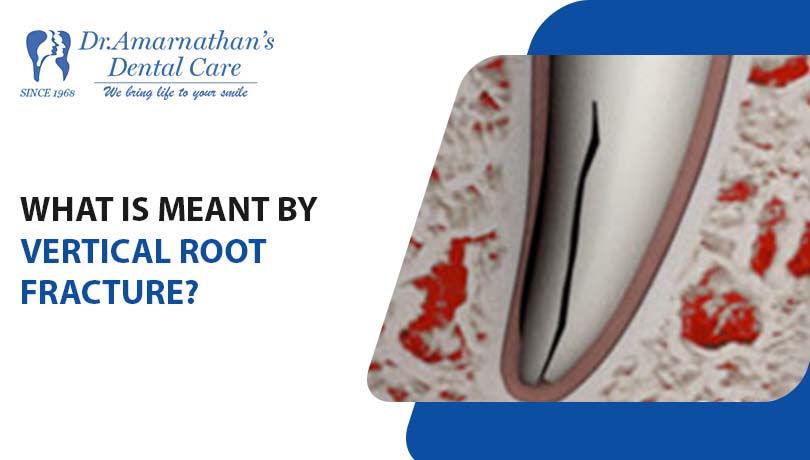 What is meant by Vertical Root Fracture?