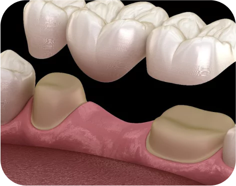 Dental Crowns & Bridges