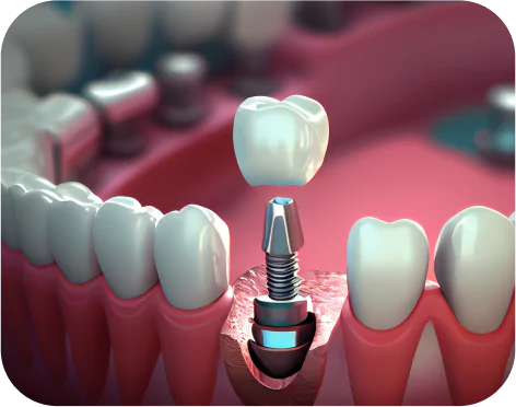 Dental implants