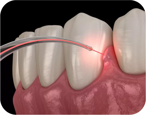 Laser Dentistry