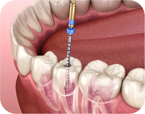 Root canal treatment