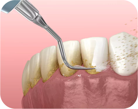 Teeth Scaling