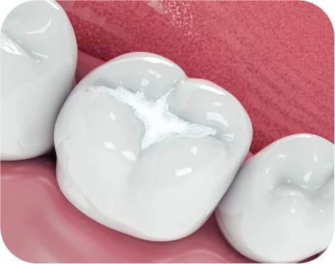 Tooth Colored Fillings