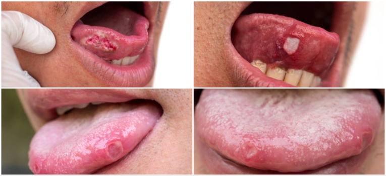 tongue ulcer images