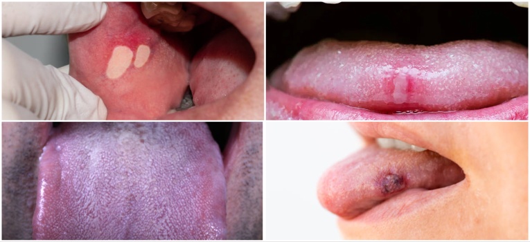 tongue ulcer pictures