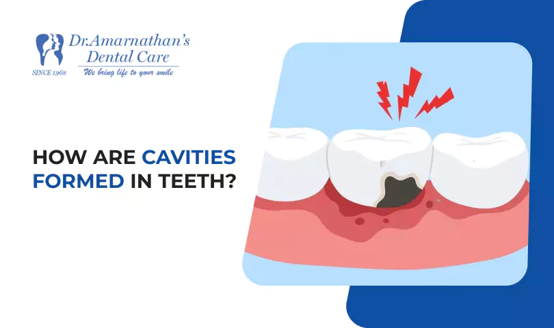 How are cavities formed in teeth?