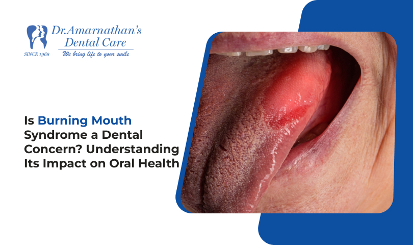 Is Burning Mouth Syndrome a Dental Concern? Understanding Its Impact on Oral Health